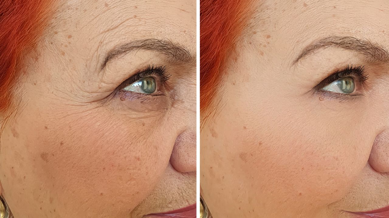 кожа до и после 40